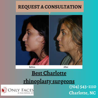 Best-Charlotte-rhinoplasty-surgeons-onlyfaces.png