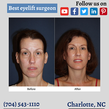 Best-eyelift-surgeon-onlyfaces.png
