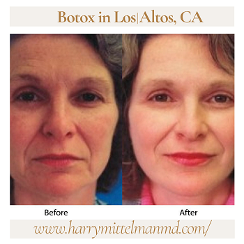 Botox-in-Los-Altos-CA-harrymittelmanmd.png