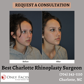 Best-Charlotte-Rhinoplasty-Surgeon-onlyfaces.png