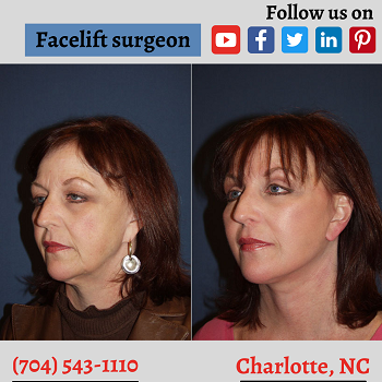 facelift-surgeon-in-Charlotte-NC-onlyfaces.png