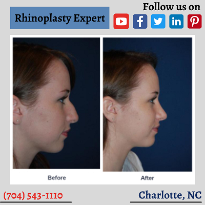 Charlotte-top-rhinoplasty-expert-onlyfaces.png