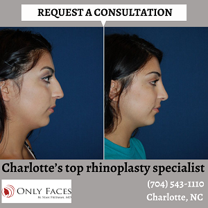 Charlotte-top-rhinoplasty-specialist-onlyfaces.png