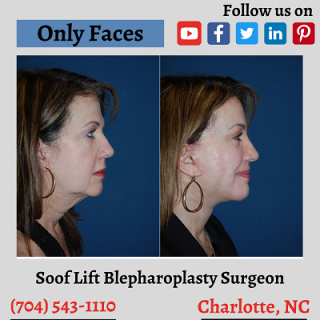 Copy-of-facelift-surgeon-in-Charlotte-NC-onlyfaces.png