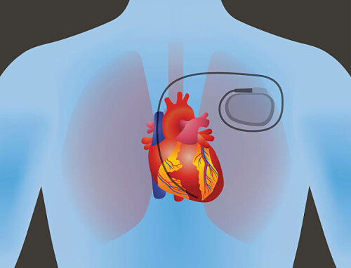 pacemaker-implantation-surgeons-in-delhi.jpeg