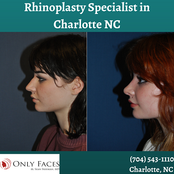 Rhinoplasty-Specialist-in-Charlotte-NC-onlyfaces.png