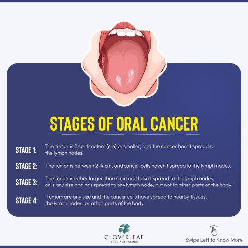 Oralcancer2.jpeg