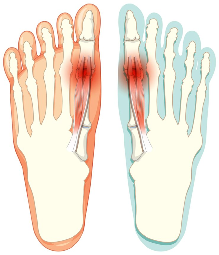 Bunion-Pain-Relief-Choosing-the-Right-Footwear.png