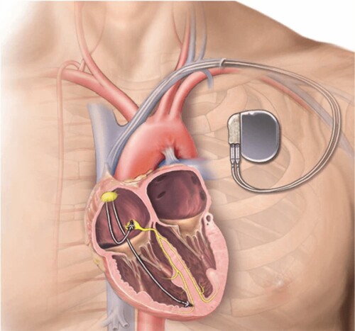 Looking for skilled pacemaker implantation surgeons in Delhi? Fortis Hospital, Shalimar Bagh boasts top-notch specialists offering expert care and advanced procedures. Schedule a consultation today for personalized treatment.