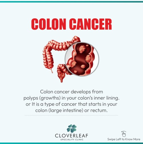 Colon-Cancer1.jpg