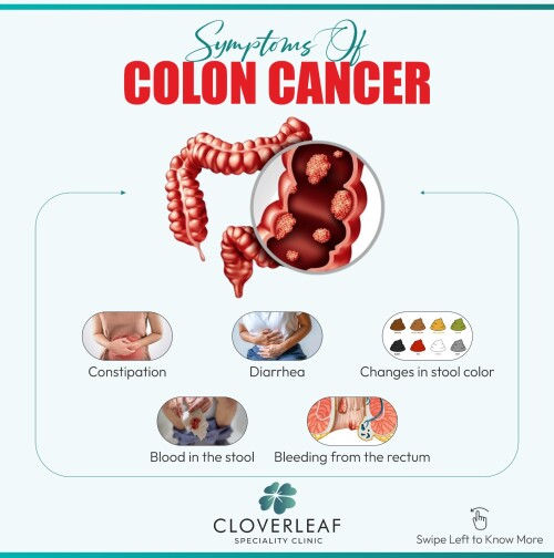 Colon-Cancer2.jpg
