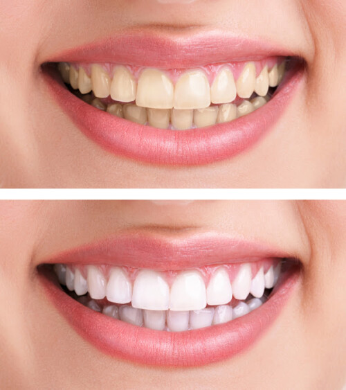 Teeth-Whitening-CA.jpg
